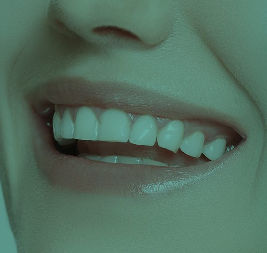 Facetas em Resina - Procedimento Odontológico