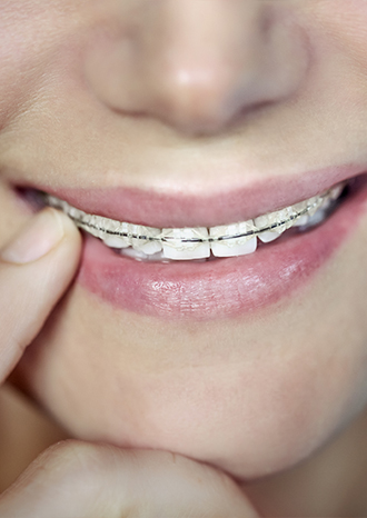 Ortodontia Preventiva - Procedimento Odontológico