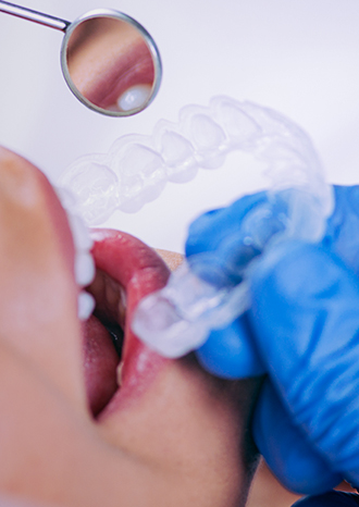 Placa Miorrelaxante - Procedimento Odontológico